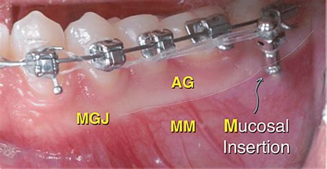 The mucogingival junction (MGJ) of the mandibular left buccal segment... | Download Scientific ...