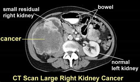 kidney anatomy