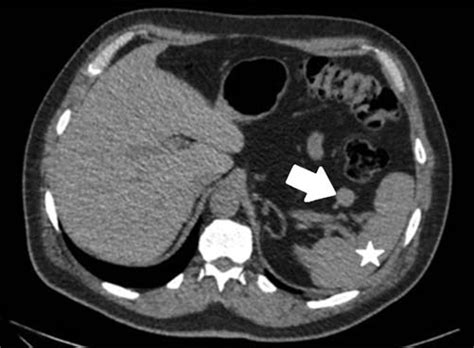 CT scan of accessory spleen at splenic hilus. Accessory spleen (arrow);... | Download Scientific ...