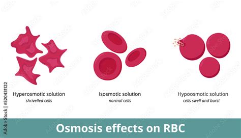 Osmosis effect on red blood cells. Depending on solution concentration (hyperosmotic, isosmotic ...