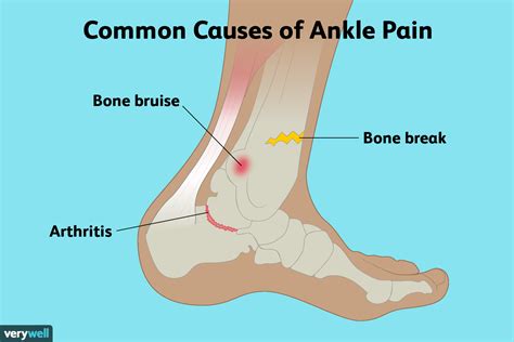 Causes of Ankle Pain and Treatment Options (2023)