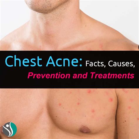 Chest Acne: Facts, Causes, Prevention, and Treatments | Consumer Health Weekly