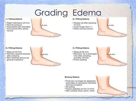 Pitting Edema: What Is It, Causes, Grading, Diagnosis,, 58% OFF