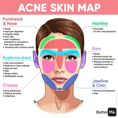 Face Map For Acne Acne Mapping Face Mapping Face Acne | The Best Porn Website