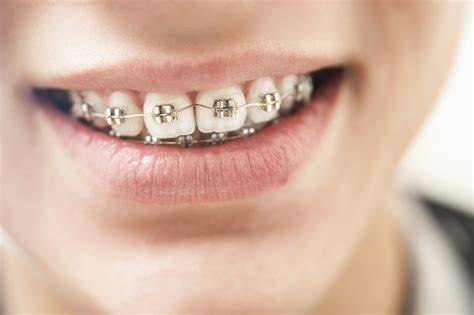 What Age Do Kids Get Braces? How to Tell If Your Child Needs Braces