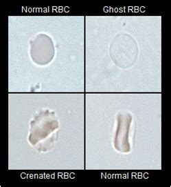 rbc morphology in urine | Medical Laboratories