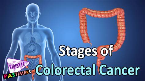 Colorectal Cancer Stages