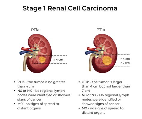 Kidney Cancer Stages | KCCure | kidney cancer | diagnosis | stages