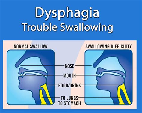 Dysphagia Treatment