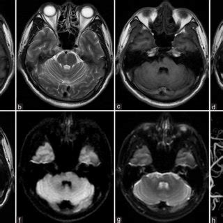 MRI findings from a 45-year-old man of 1 year after primary pons ...