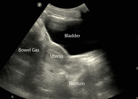 Normal Bladder Ultrasound