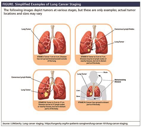 Progression of small cell lung cancer