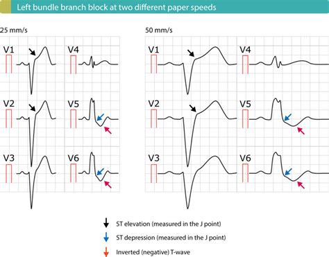 Left bundle branch block (LBBB): ECG criteria, causes, management – Cardiovascular Education