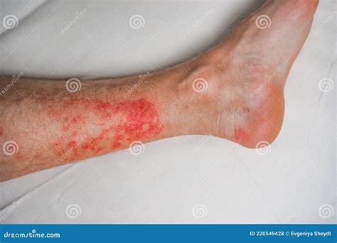 Eczema Skin Disease on the Legs, Itchy Red Rashes and Spots Stock Photo ...