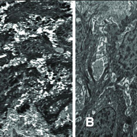 Electron micrograph showing a) regular basal lamina ( black arrow),... | Download High-Quality ...