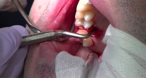 9 Signs You Should Get a Wisdom Tooth Extraction | Dentistry | Dentagama