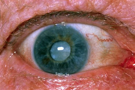 Cataract Surgery - Types, Recovery Time, Complications