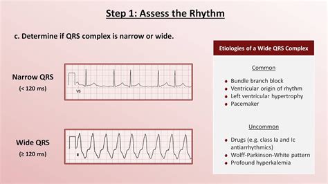 Www ecg interpretation