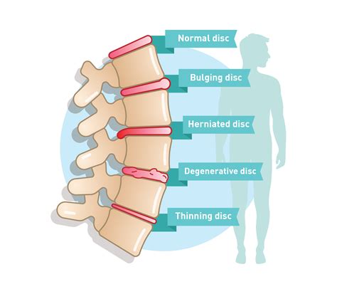 Lumbar Herniated Disc X Ray