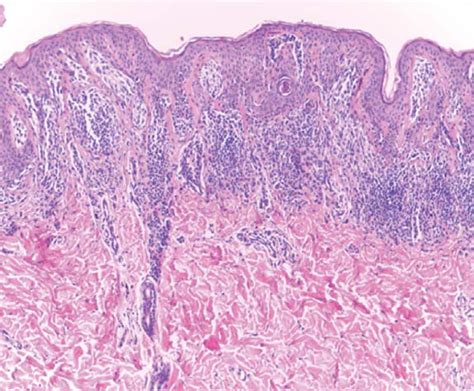 Dysplastic nevus, moderate dysplasia HE 100x. | Download Scientific Diagram