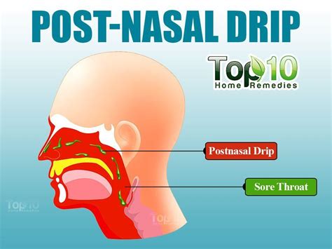 Illustration Showing Post Nasal Drip | Stuffy nose remedy, Post nasal ...