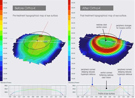 Ortho K vs Multifocal Soft Contact Lenses (Part 1) – My Kid's Vision – Medium