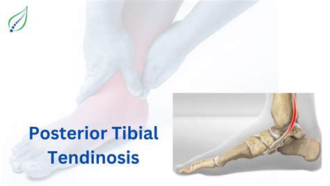 Understanding Tibial Tendinosis: Causes, Symptoms, and Treatment | Best ...