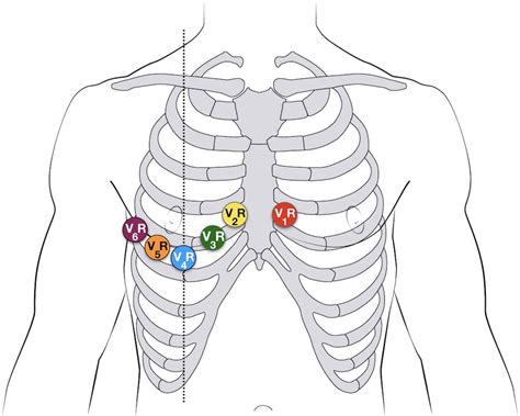 ECG Lead positioning • LITFL • ECG Library Basics