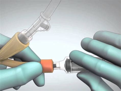 How to Remove a Catheter - Catheter Supply Company