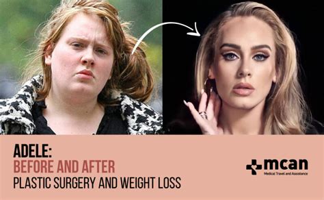 Adele Before and After Her Transformation | MCAN Health