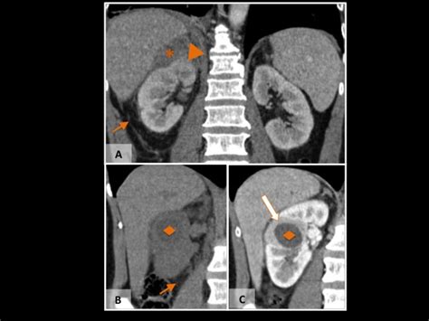 Complicated pyelonephritis. A. Coronal enhanced CT scan show a ...