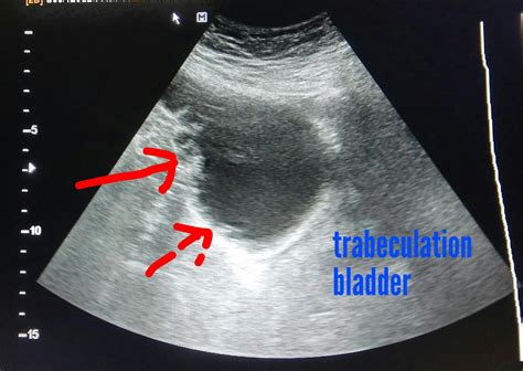 Ultrasound imaging: Urinary-bladder-trabeculation-3D-ultrasound