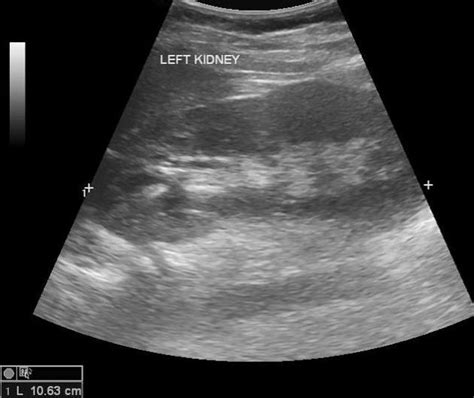 Pyelonephritis Ultrasound