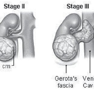 Stages of tumor growth in kidney. | Download Scientific Diagram