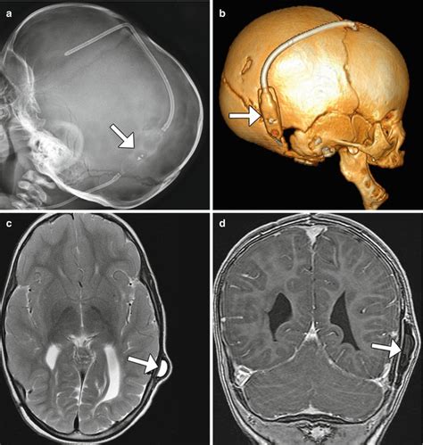 Codman Programmable Shunt Brain