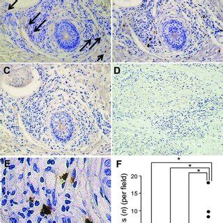 Immunohistochemistry of basophils in leprosy skin lesions. Positive... | Download Scientific Diagram