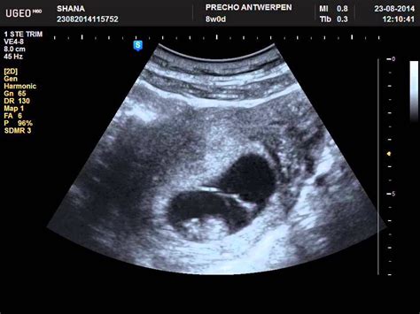 pregnant but can't see baby on ultrasound - Dorthea Spangler