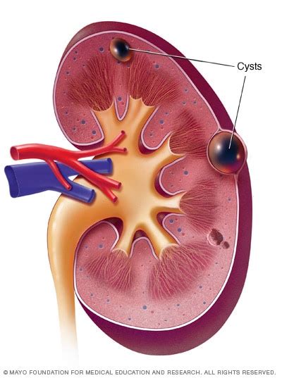 Kidney cysts - Symptoms and causes - Mayo Clinic