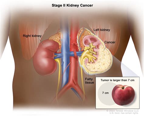 Renal Cell Cancer Treatment - NCI