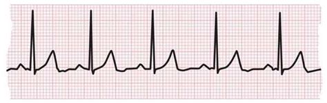 Electrocardiogram (ECG or EKG) | American Heart Association