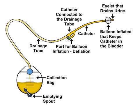 Details more than 77 types of urinary catheter bags - esthdonghoadian