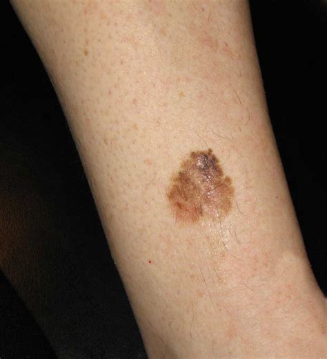 melanoma-0.35mm - "marsden skin cancer clinic"