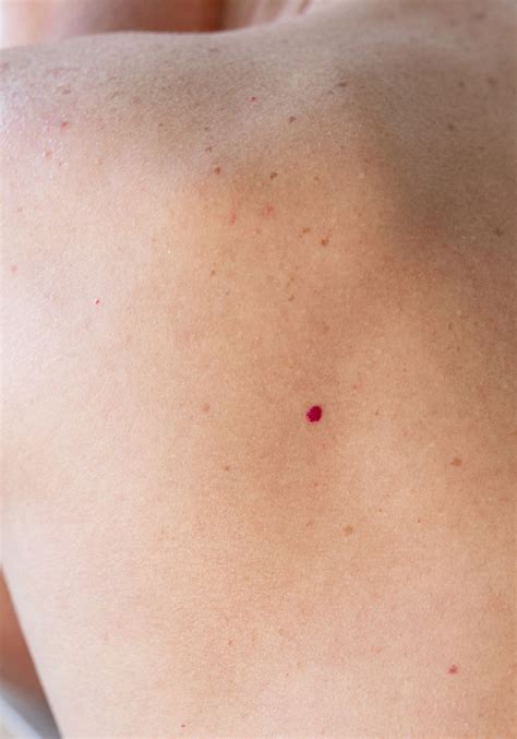 Cherry Angiomas – Laser and Skin Clinics