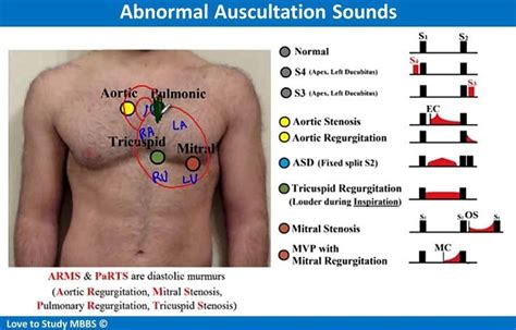 Abnormal Auscultation Sounds in 2021 | Aortic stenosis, Med school ...