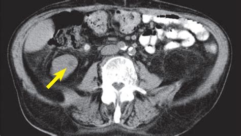 Abdominal CT scan shows small primary renal tumor in the the right... | Download Scientific Diagram