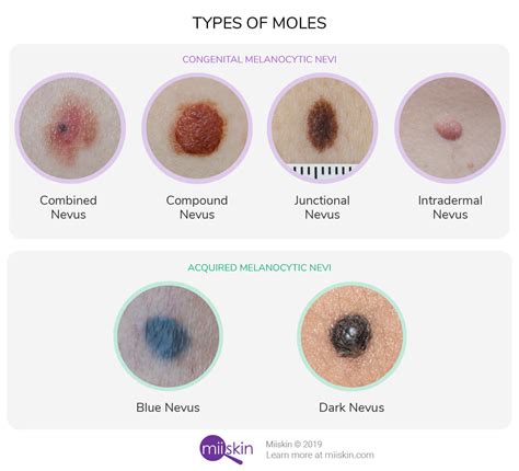 About Moles - Types, Warning Signs, Causes, and Prevention