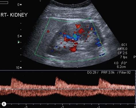 Ultrasound of the renal tract | Radiology Key