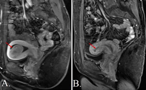 Uterine Artery Embolization - Fibroids | UCLA Health