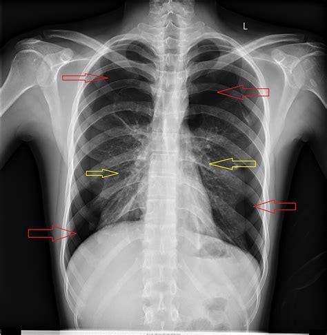 Cureus Simultaneous Bilateral Spontaneous Pneumothorax A Rare | The ...