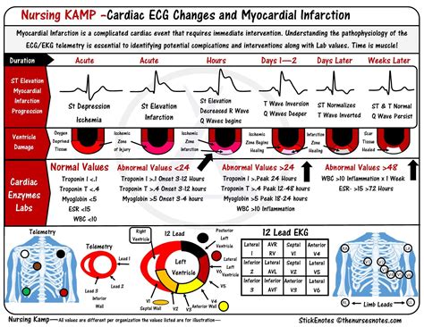 ST elevations monitoring for Infarction STEMI Electrocardiogram ECG EKG Cardiac and Telemetry ...